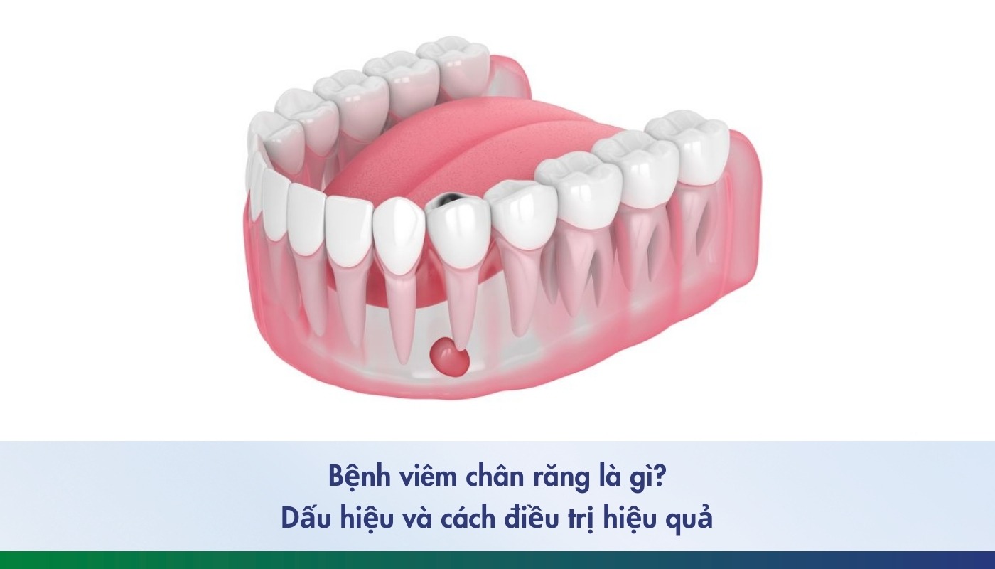 Cách nhận biết và điều trị bệnh viêm chân răng