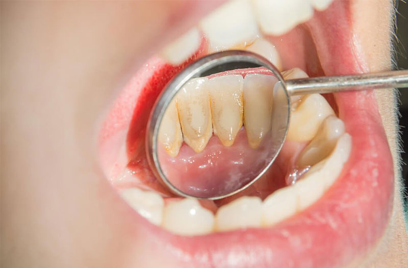 Bác sĩ đang dùng gương nha để kiểm tra tình trạng cao răng mặt sau của hàm