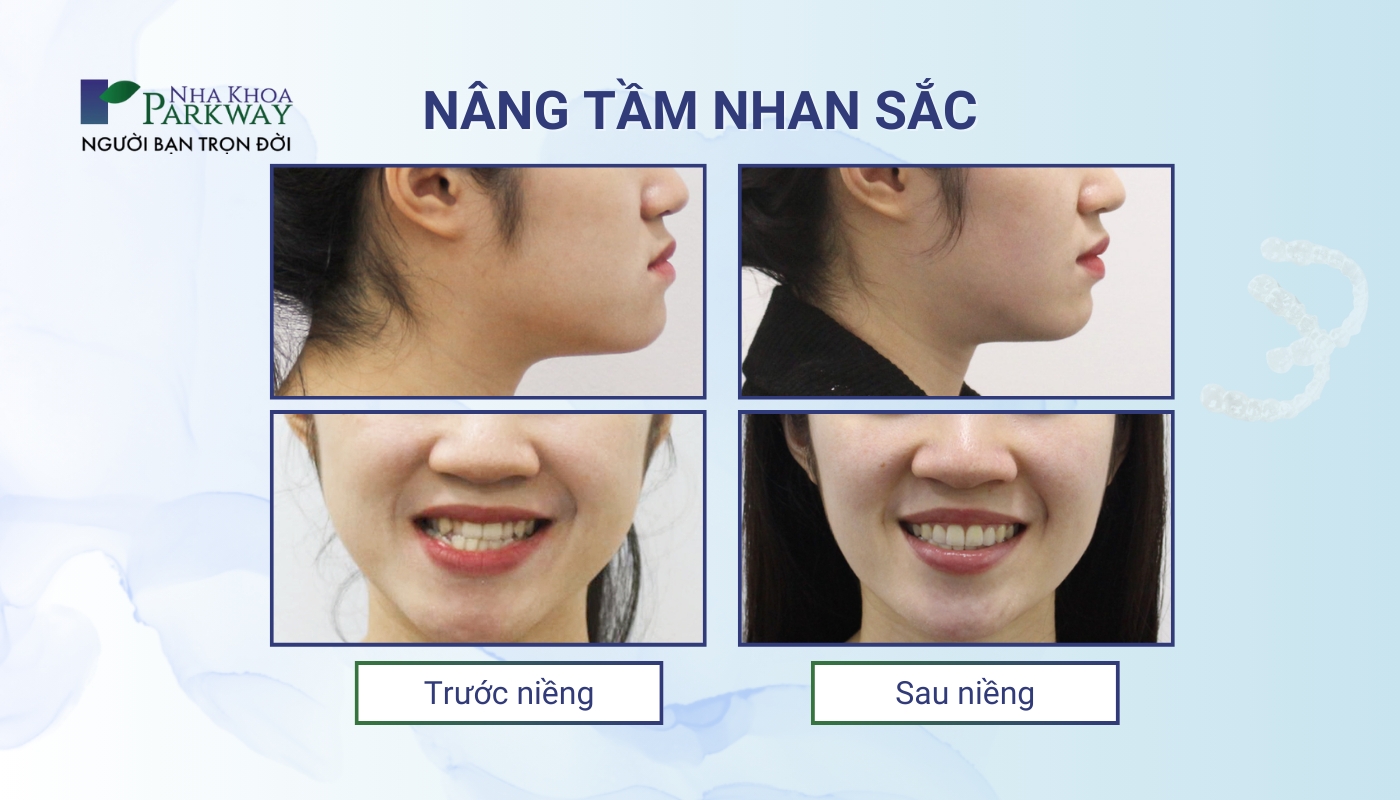 Nâng tầm nhan sắc: Hình ảnh cô gái trước và sau khi niềng răng