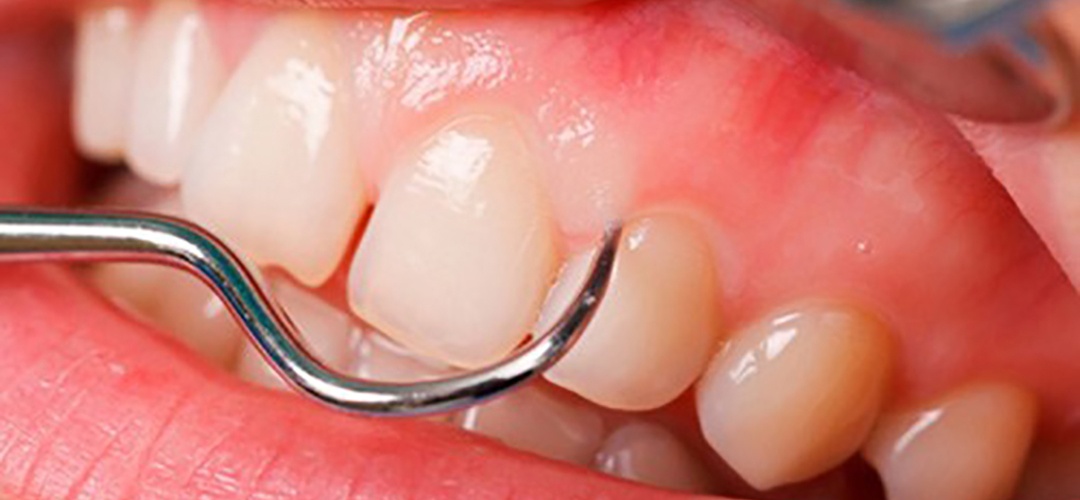 Bác sĩ dùng dụng cụ để khám răng trước khi thực hiện trám sealant