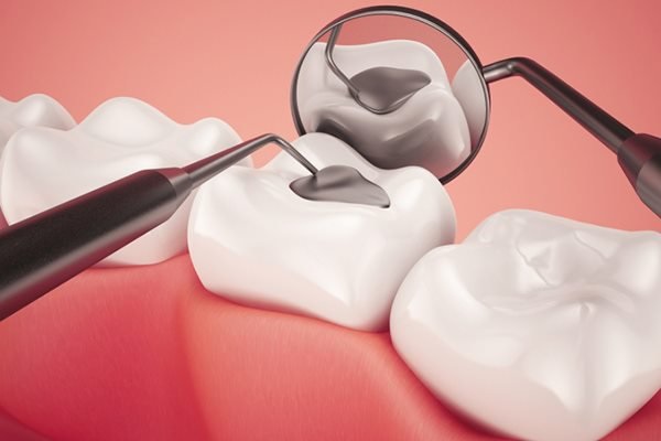Hình ảnh mô phòng răng sâu đã được trám và đang được kiểm tra lại