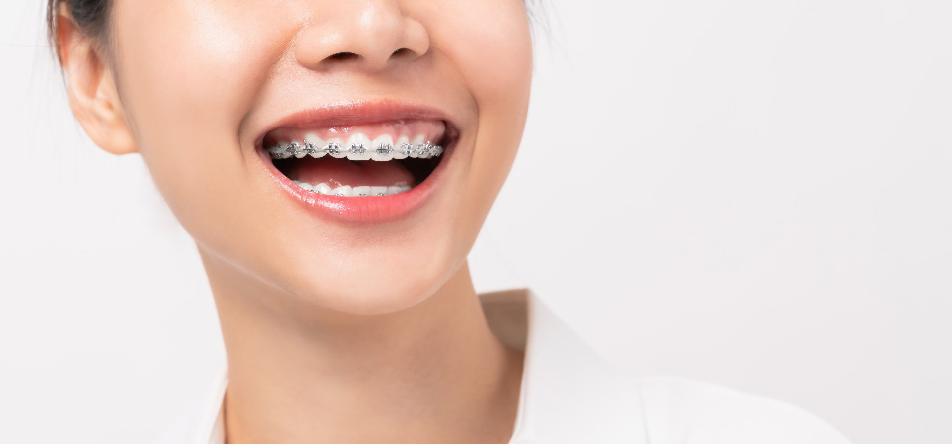 Cô gái đang cười rạng rỡ với hàm răng được niềng mắc cài