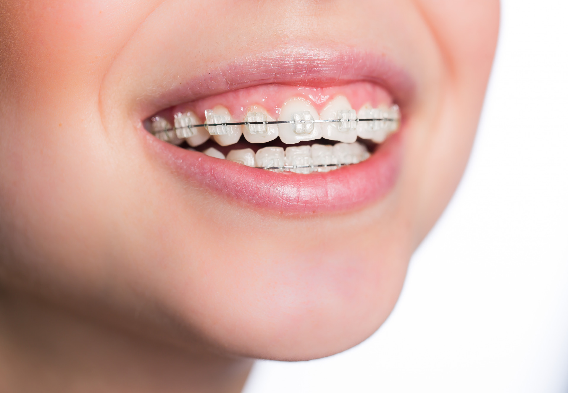 Niềng năng mắc cài sứ pha lê dùng dây cung, mắc cài dà dây thun đẩy răng về đúng vị trí