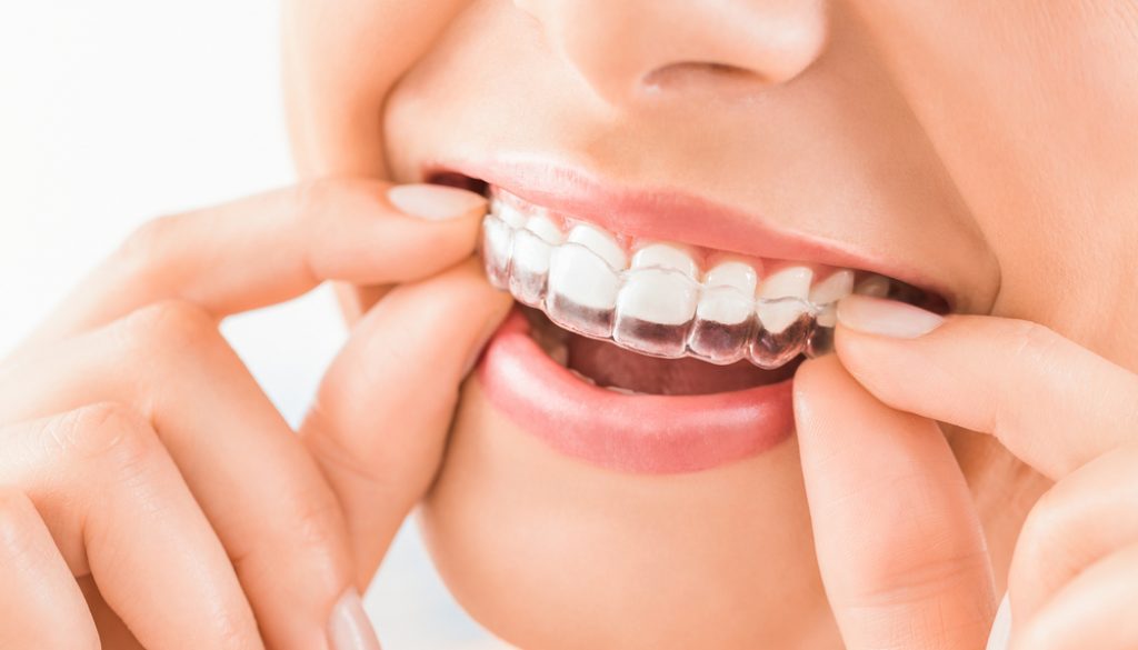 Khay niềng răng trong suốt dễ dàng tháo lắp và dễ vêị sinh