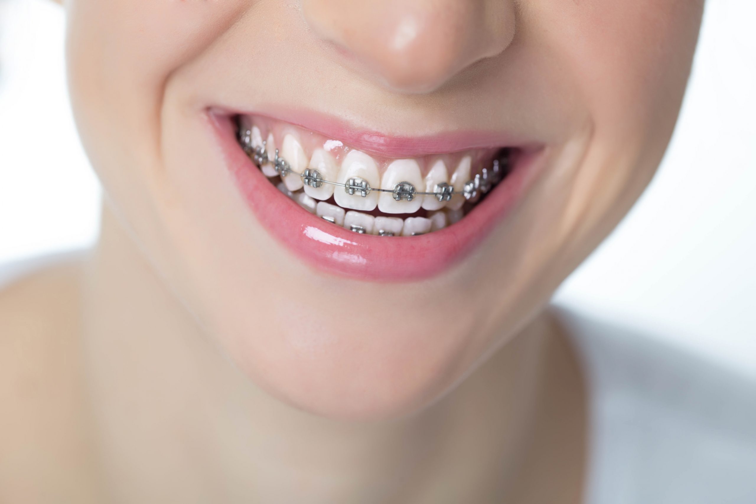 Cô gái niềng răng mắc cài đang cười tươi