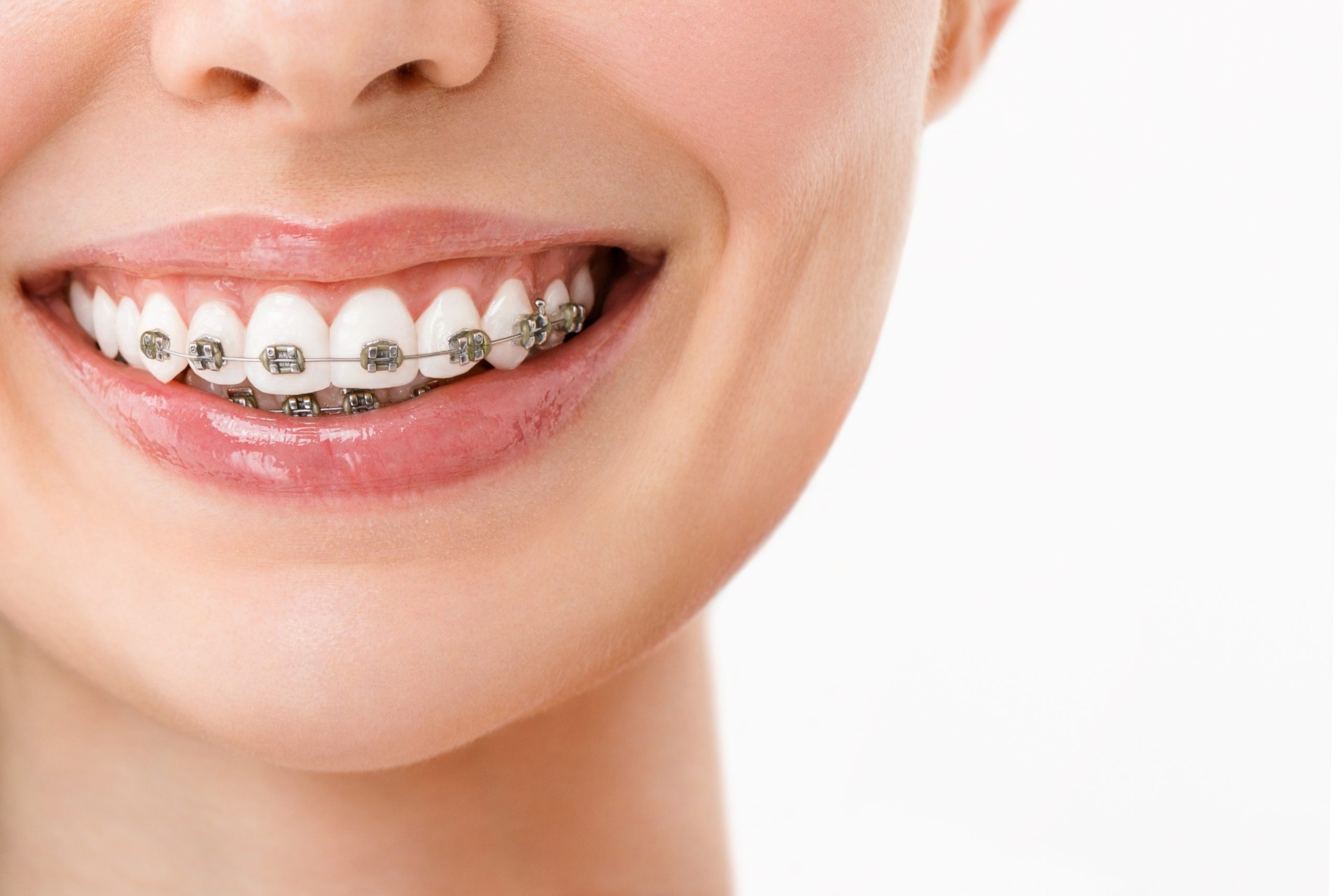 Gói niềng răng mắc cài kim loại mức độ 2