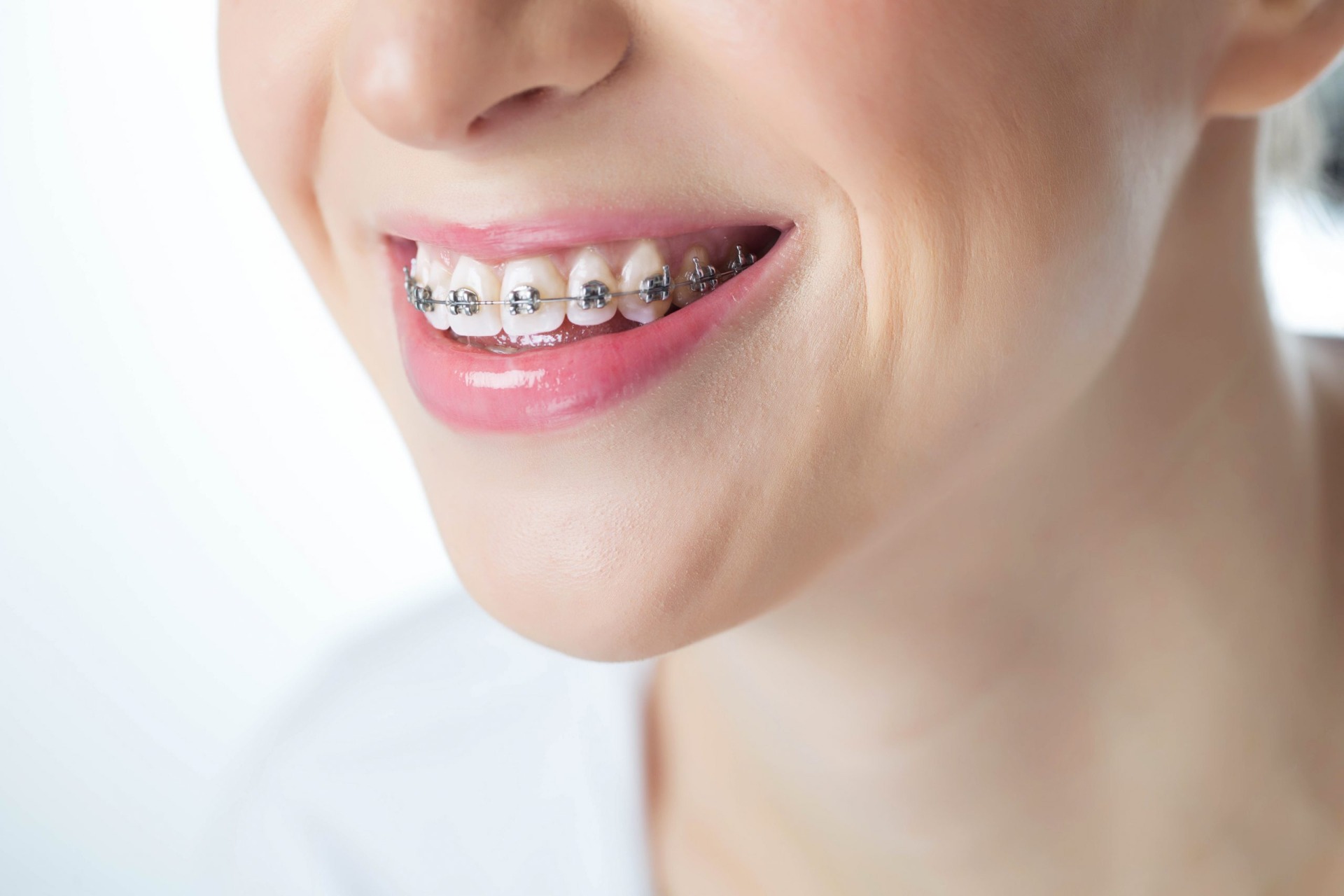Cô gái niềng răng mắc cài kim loại tự động