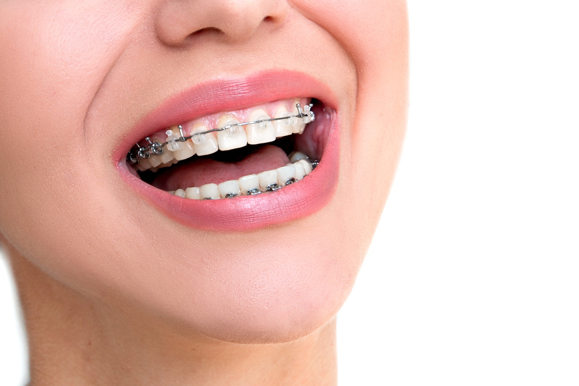 Cô gái với nụ cười tự tin khi niềng răng mắc cài sứ
