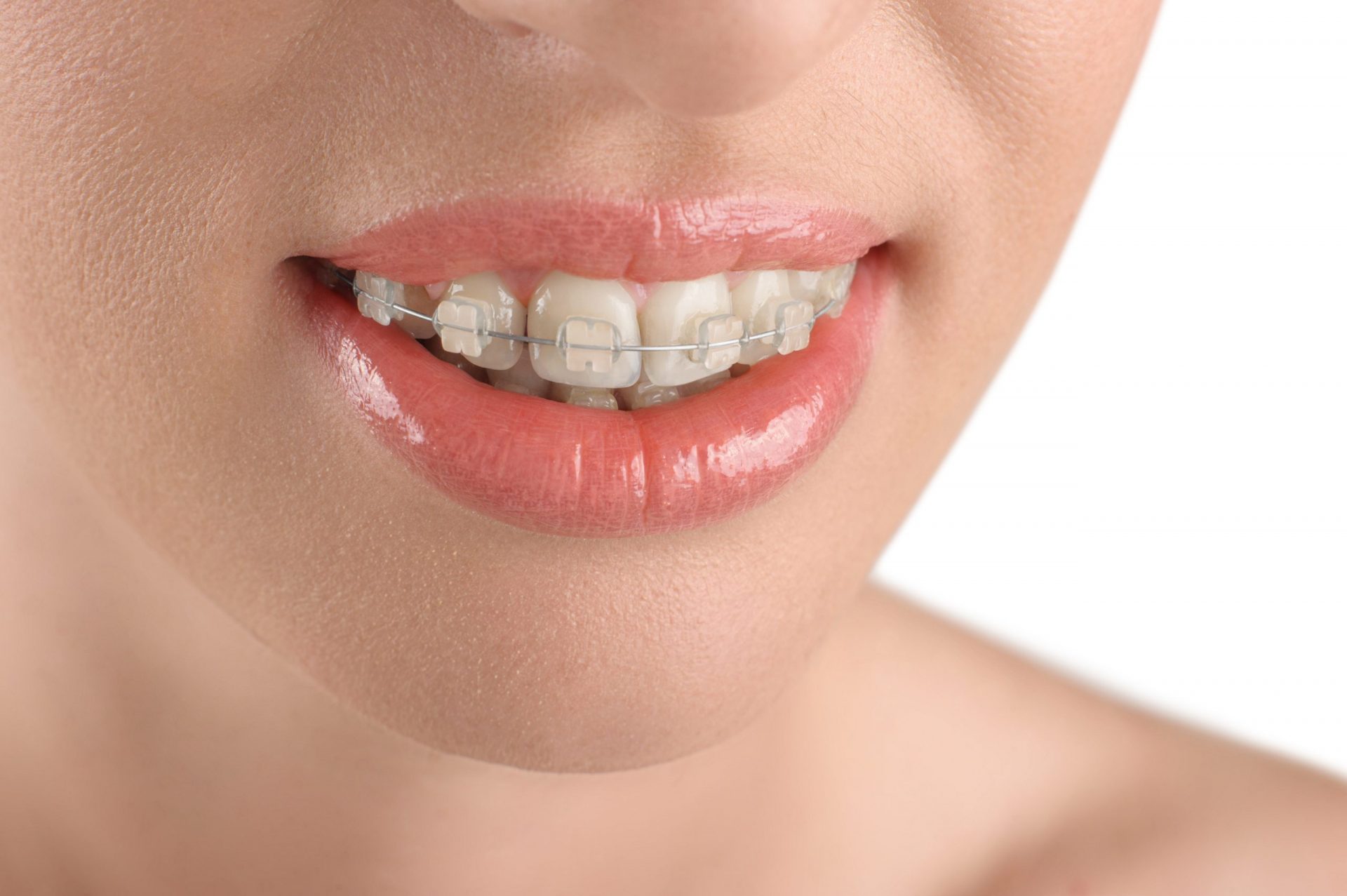 Cô gái được gắn mắc cài niềng răng sứ