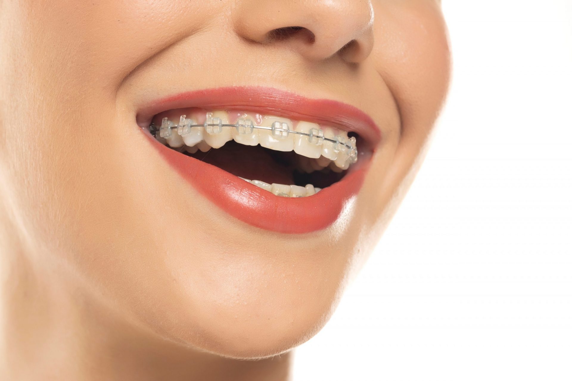 Cô gái cười tươi khi niềng răng mắc cài sứ