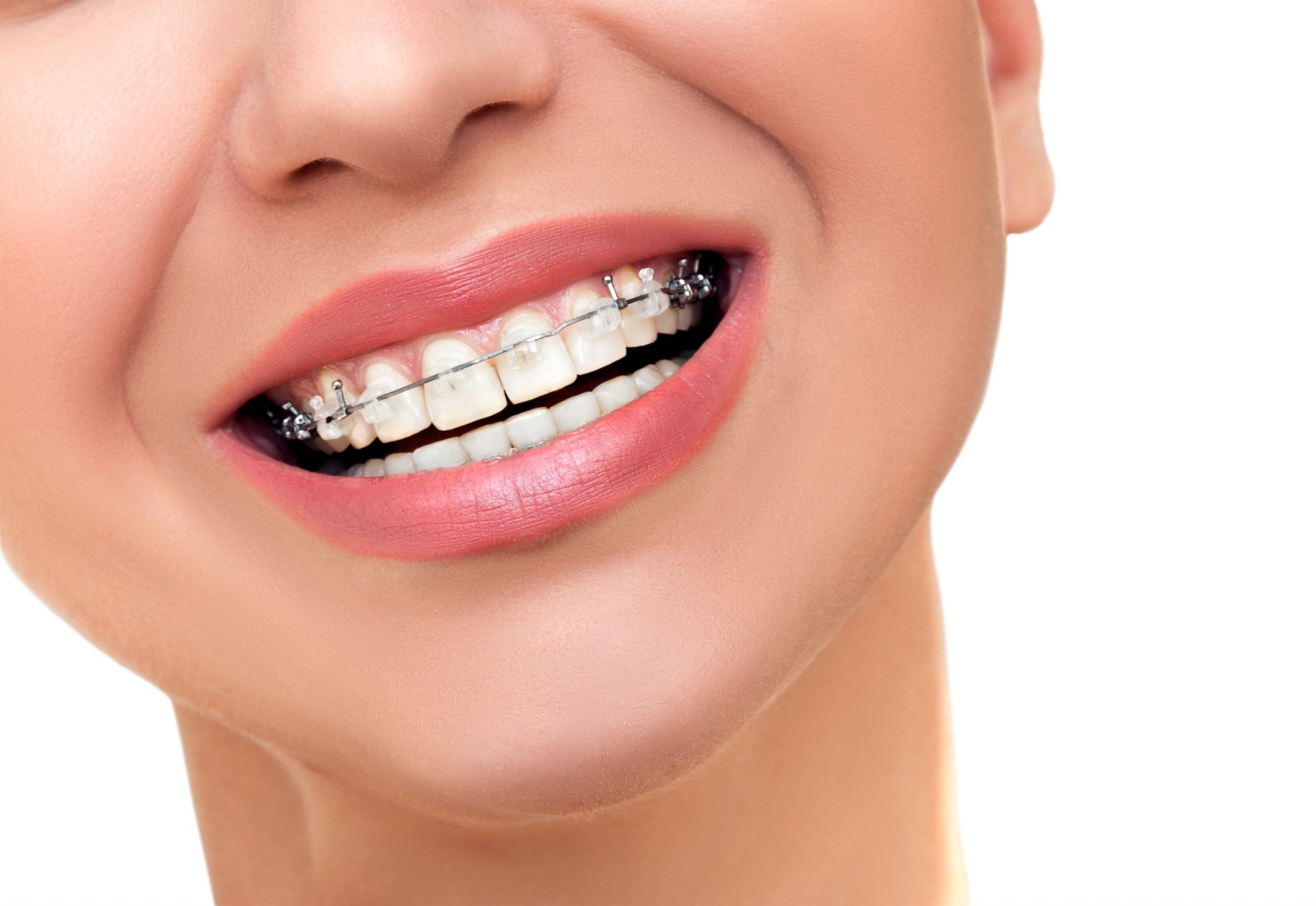 Niềng răng mắc cài