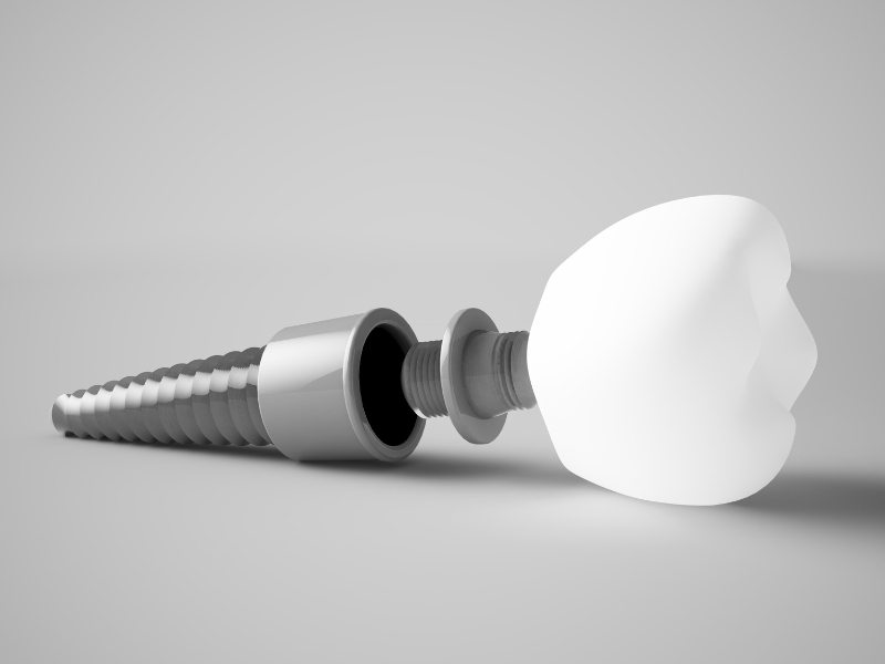 Hình ảnh trụ Implant Straumann và răng sứ