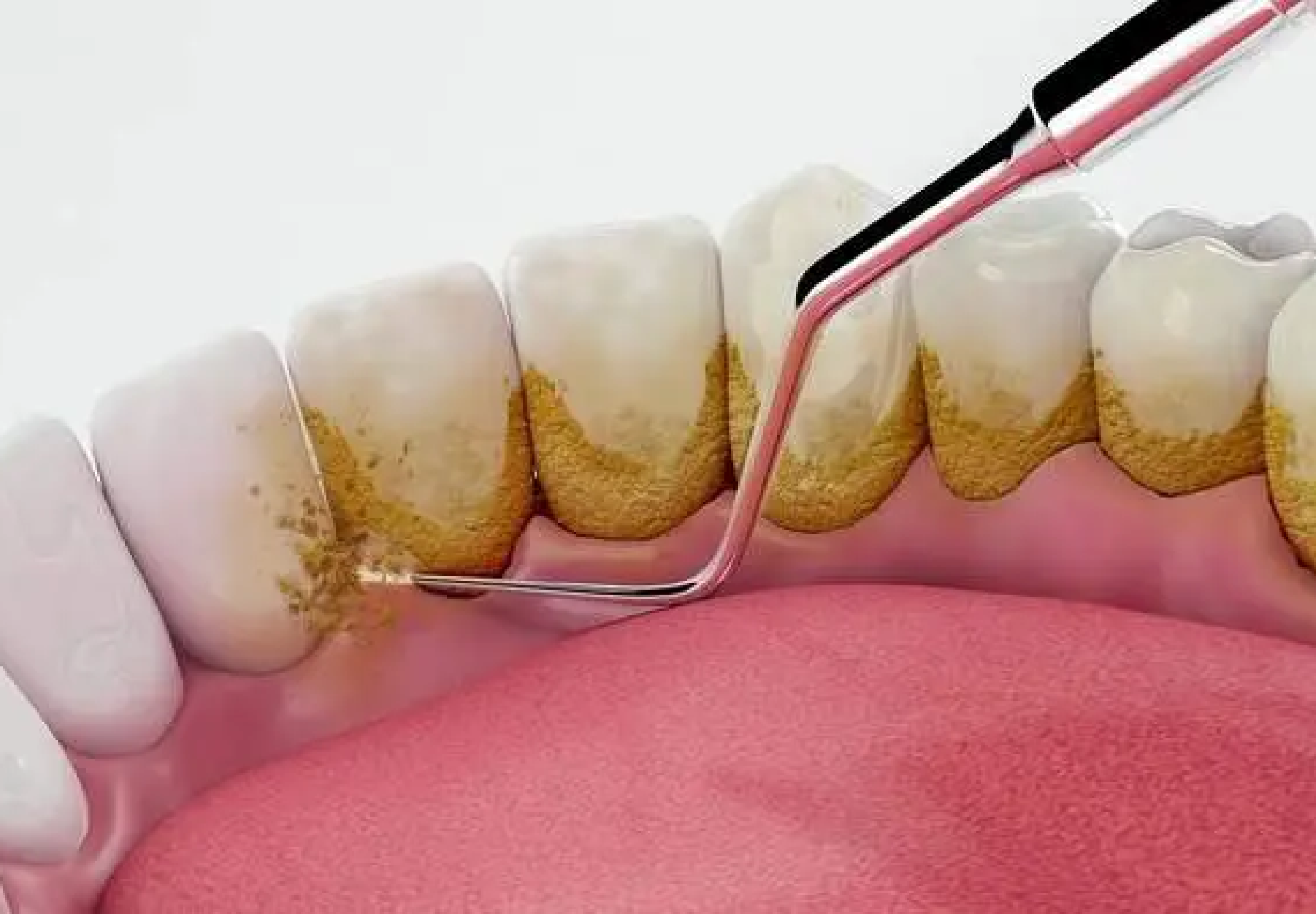 Lấy cao răng mặt trong của hàm