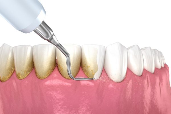 Lấy cao răng mặt ngoài hàm răng dưới