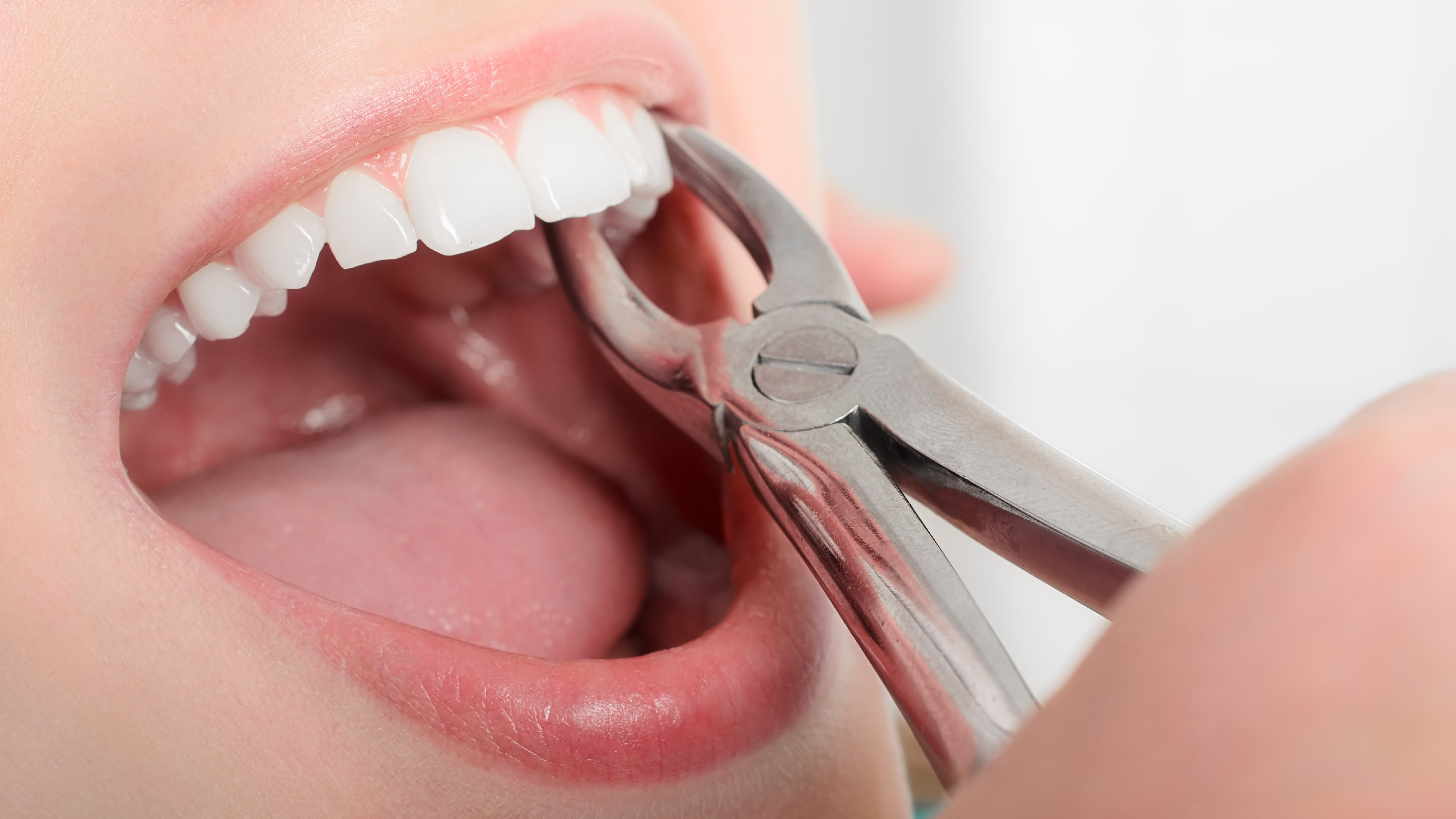 Bác sĩ đang thực hiện nhổ răng một cách nhẹ nhàng không đau