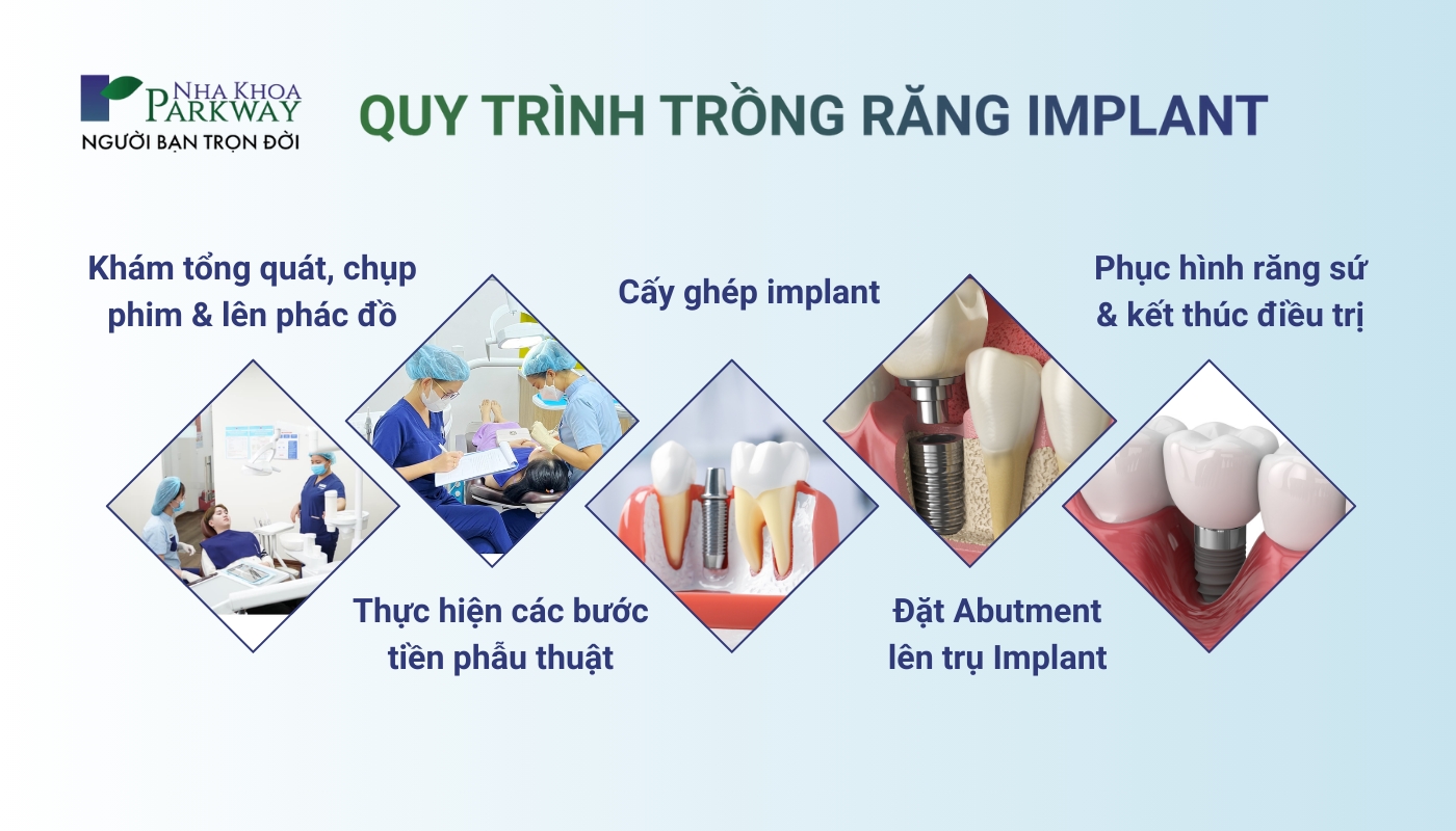 Quy trình trồng răng implant: 1-Khám tổng quát, chụp phim và lên phác đồ, 2-Thực hiện các bước tiền phẫu thuật, 3-Cấy ghép implant, 4-Đặt abutment lên trụ implant, 5-Phục hình răng sứ và kết thúc điều trị