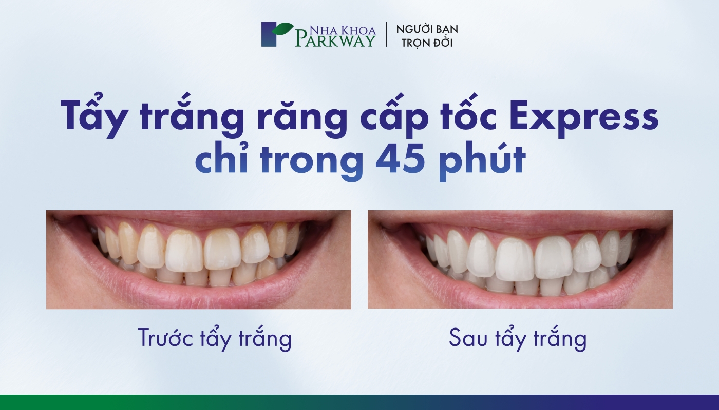Dịch vụ tẩy trắng răng cấp tốc Express tại Parkway