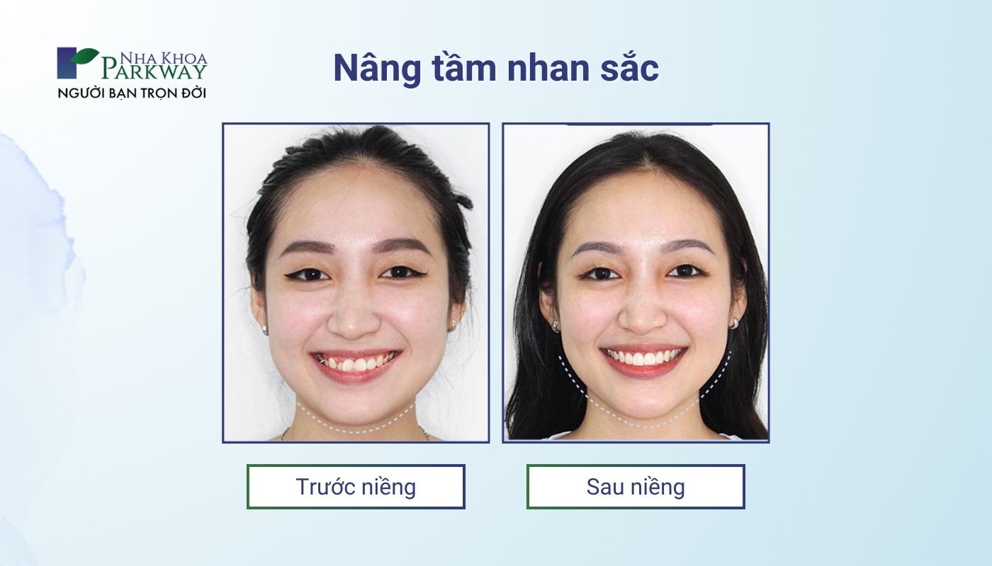 Nâng tầm nhan sắc: khách hàng trước và sau khi niềng răng