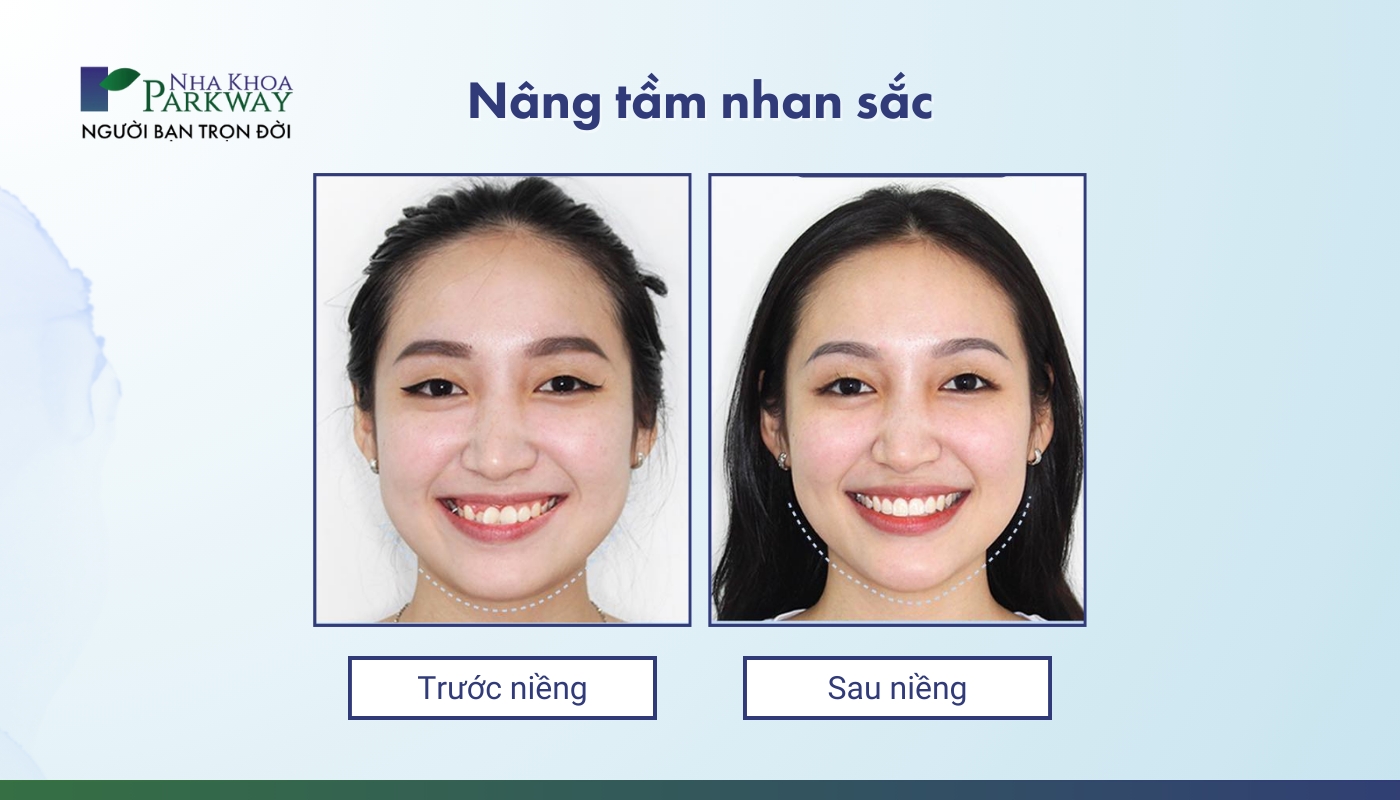 Nâng tầm nhan sắc: Hình ảnh trước và sau khi niềng