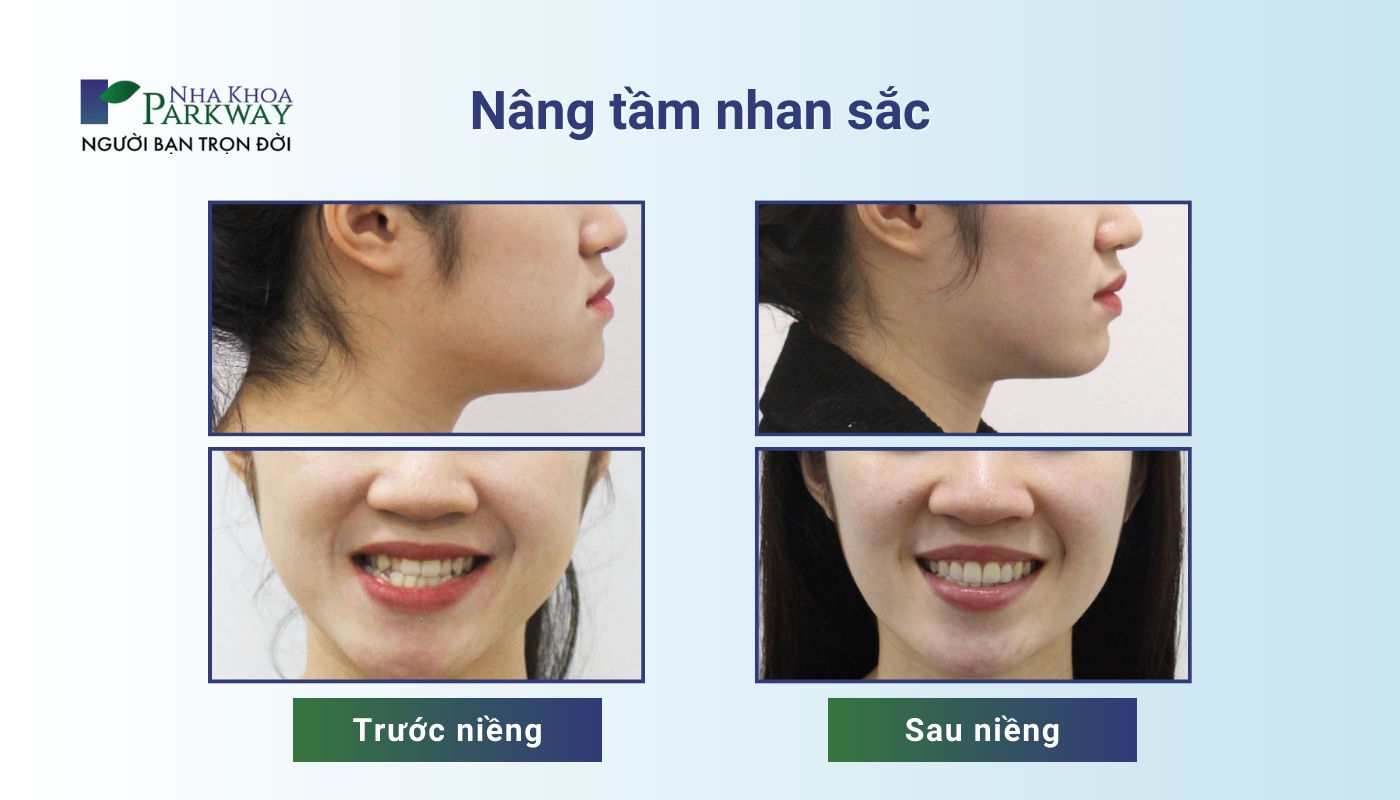 Cô gái có nụ cười tươi xinh sắn và hình ảnh trước - sau khi niểng răng