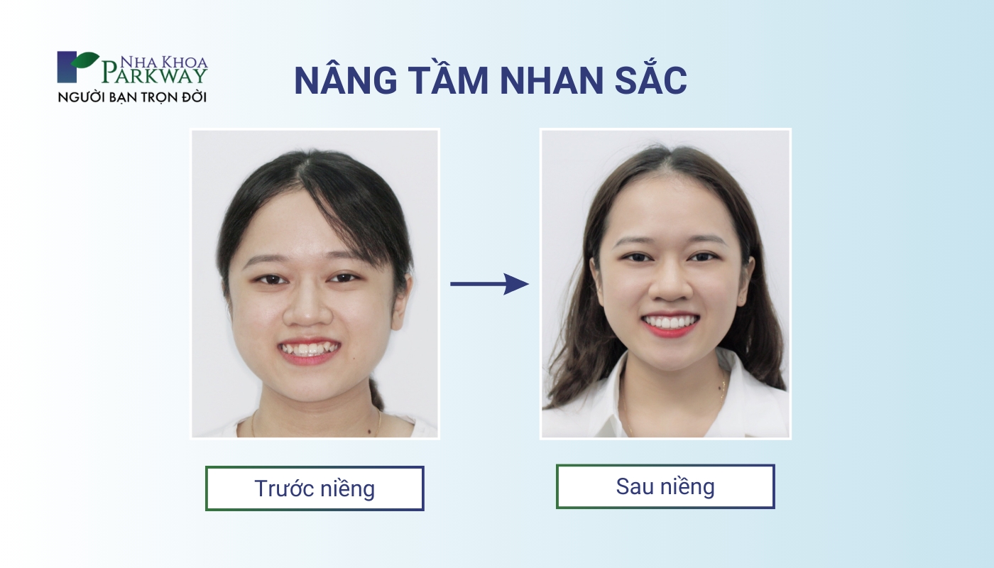 Cô gái nâng tầm nụ cười nâng tầm nhan sắc sau khi niềng răng mắc cài