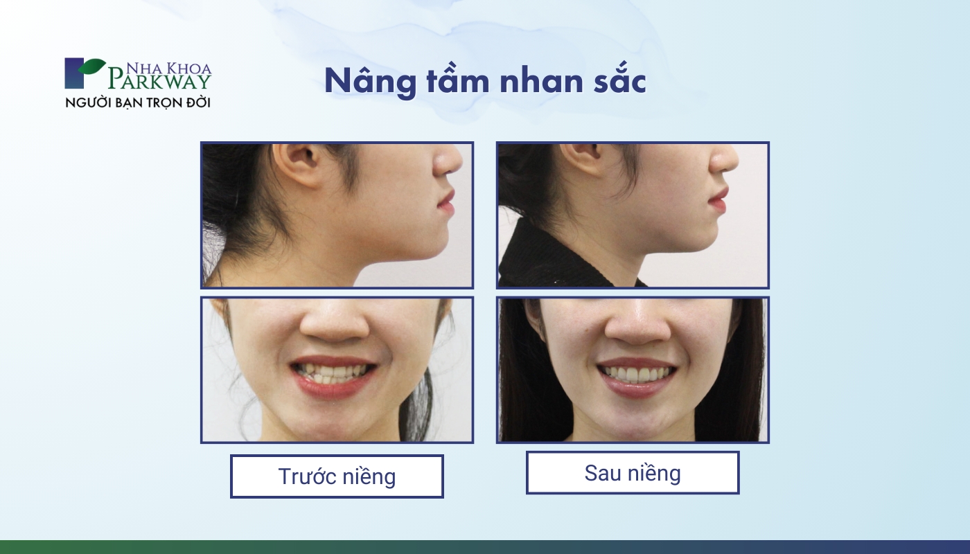 Trước và sau khi niềng: Nâng tầm nhan sắc