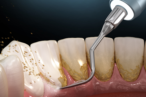 Bác sĩ thực hiện lấy cao răng và vệ sinh mặt trong răng bằng tăm nước một cách nhẹ nhàng