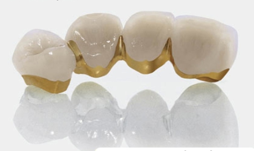 Hình ảnh răng sứ titan